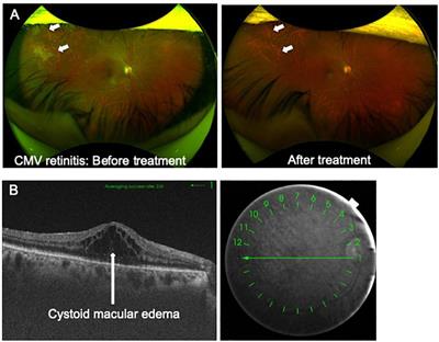 HTLV-1 in Ophthalmology